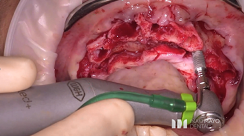 Azure Clinical Case 4: 10 Implants full arch case in maxilla and bone grafted - Image 2