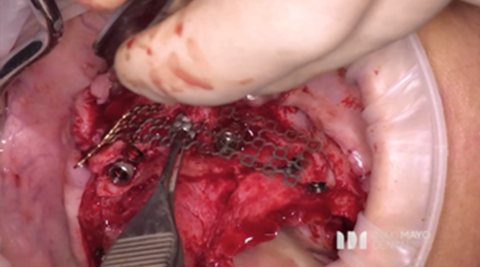 Azure Clinical Case 4: 10 Implants full arch case in maxilla and bone grafted - Image 4