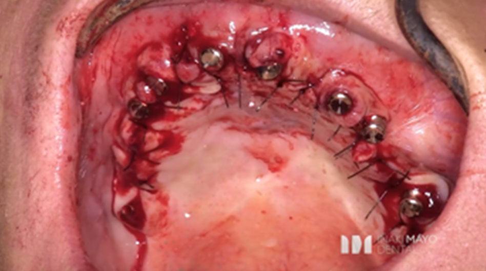 Azure Clinical Case 4: 10 Implants full arch case in maxilla and bone grafted - Image 7