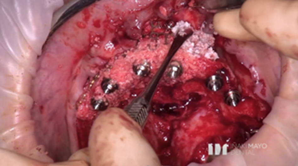 Azure Clinical Case 4: 10 Implants full arch case in maxilla and bone grafted - Image 5