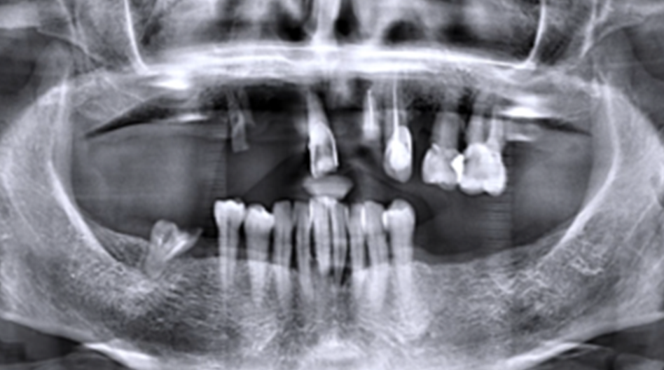 Azure Clinical Case 4: 10 Implants full arch case in maxilla and bone grafted - Image 1
