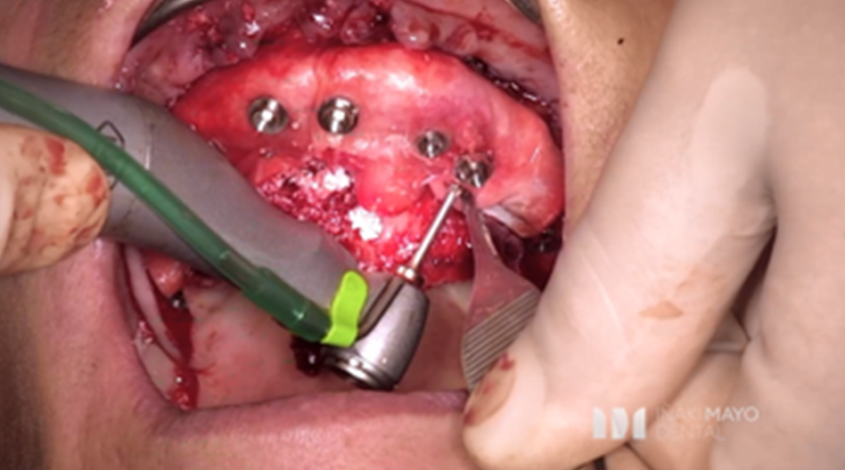 Azure Clinical Case 4: 10 Implants full arch case in maxilla and bone grafted - Image 6