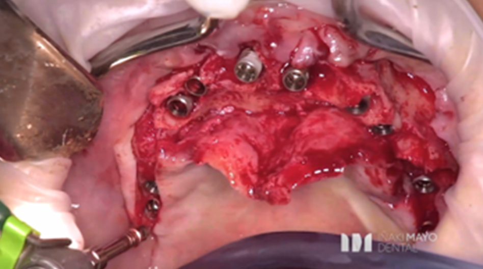 Azure Clinical Case 4: 10 Implants full arch case in maxilla and bone grafted - Image 3